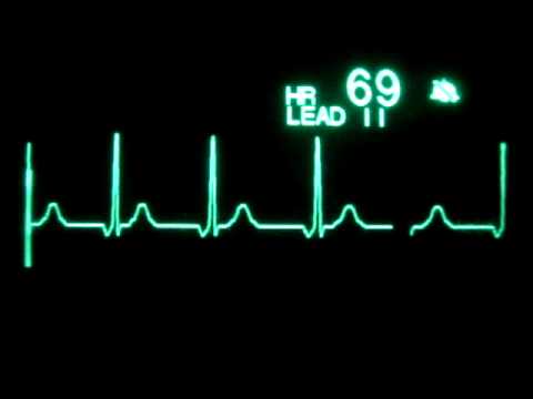 ECG Video: Idioventricular Rhythm. 0:14. Another arrhythmia, seen often in 