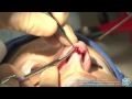 Open rhinoplasty or nose job plastic surgery