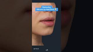 The Dark Side Of Silicone Lip Injections A Warning