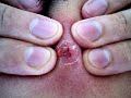 zit