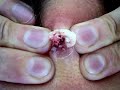 zit
