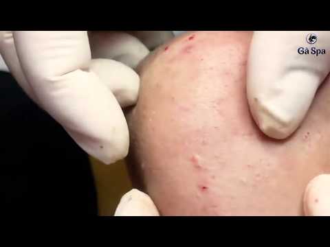 Have a look at Blackheads on left cheek and how we treat them • Gà Spa