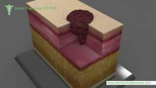 Mohs Micrographic Surgery By Dr Palamaras