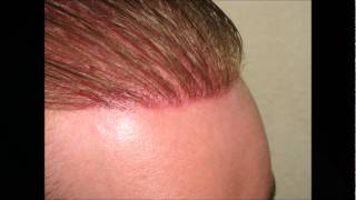 Exoderm I.M.C - Biofibre or Nido Artificial Hair Transplant Best Synthetic hair implant