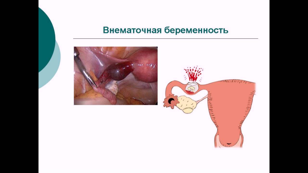 Внематочная беременность бывает из-за