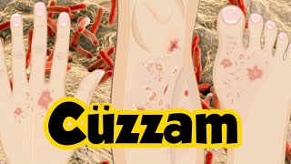 Cüzzam Hastalığı Nedir? Sağlık Videoları