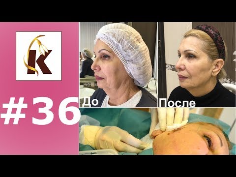 Нити DUAL ARM, до и после, подтяжка лица в нескольких направлениях одной нитью. Нити DUAL ARM, до и после, подтяжка лица в нескольких направлениях одной нитью.