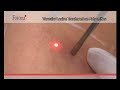 VASCULAR LESION TREATMENT ON EXTREMITIES
