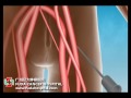 micro catheter