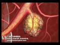micro catheter