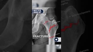Top 5 Hip Fracture Repair Options