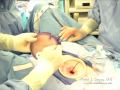 GelPoint - How to insert for single incision laparoscopy
