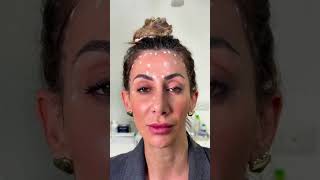 Smas Lifting With Botox A Non-Surgical Facelift Alternative