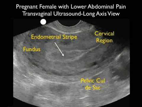 Ectopic Pregnancy Case Study - Part 1 - YouTube