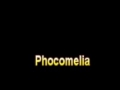 phocomelia