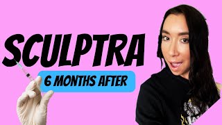 Sculptra- 6 Months Beforeafter 4 Vials. Overview Of My Experience