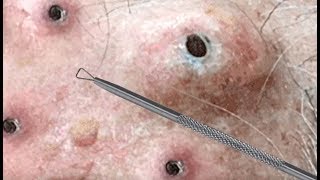 Most Popular Dilated Pores of All Time - 13,000,000 Views!