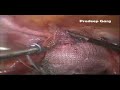 vaginal vault prolapse with voice.mpg