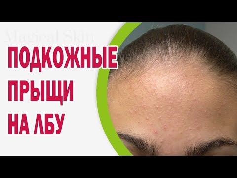 На лбу прыщи как лечить 65