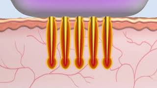 The Secret Micro-Needle Fractional RF - How it works by Dr V - V Boutique Aesthetics