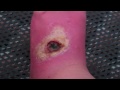 Spider Bite Wound After Four Months Caution Disturbing To Watch images Spider Bite Wound After Four Months Caution Disturbing To Watch
