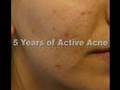 The Acne Practice (Caucasian 1)