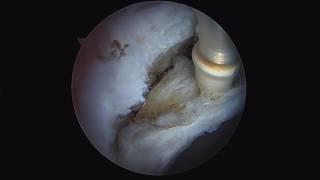 Velox Hip Arthroscopy Ablator