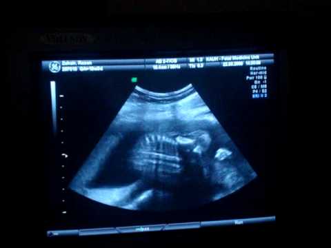 3d ultrasound pictures at 20 weeks. Ultrasound Sonogram - 20 Weeks