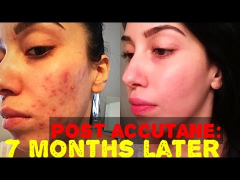 Accutane Month 3