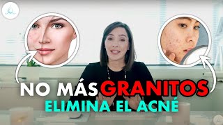 El acné desaparecerá de tu cara sin dejar rastro, Dra Pilar Ochoa - Dermatología