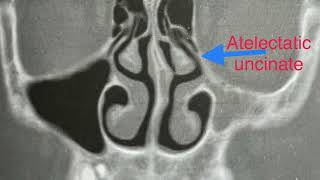 Uncinate Process Variation And Clification