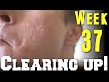 Week 37 Accutane Adventures: Friend of Mine, Accutane Costs & Acne in Competition