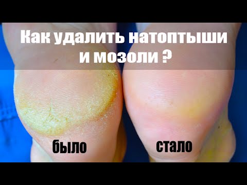 Убрать натоптыши в домашних условиях отзывы 508