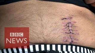 China organ trafficking: 'I sold my kidney for £4,000' - BBC News