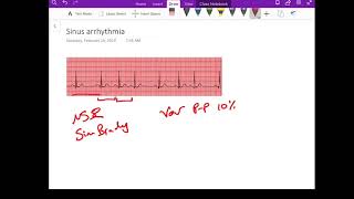 Sinus Arrhythmia - Dr Jamal USMLE - cardiology ECG lecture