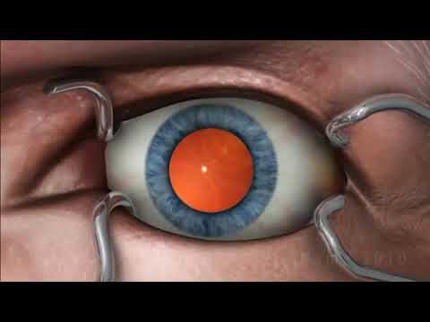 phacoemulsification3D