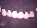 DR.GERARD CUOMO | Porcelain Veneers 4 | Cosmetic Dentistry | Boca Raton | Florida