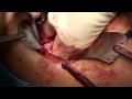 Cholangiocarcinoma (Bile Duct Cancer) Surgery