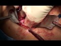 Cholangiocarcinoma (Bile Duct Cancer) Surgery