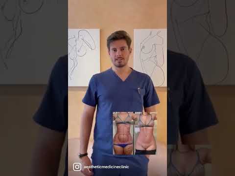 Liposcultura