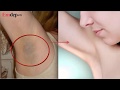 TRỊ THÂM ĐEN NÁCH trong 2 tuần nhờ nguyên liệu rẻ tiền nhà nào cũng có