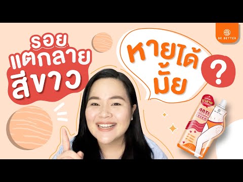 รอยแตกลายสีขาว รักษาหายไหม? ขาแตกลาย ท้องแตกลาย แขนแตกลาย ทำไงดี