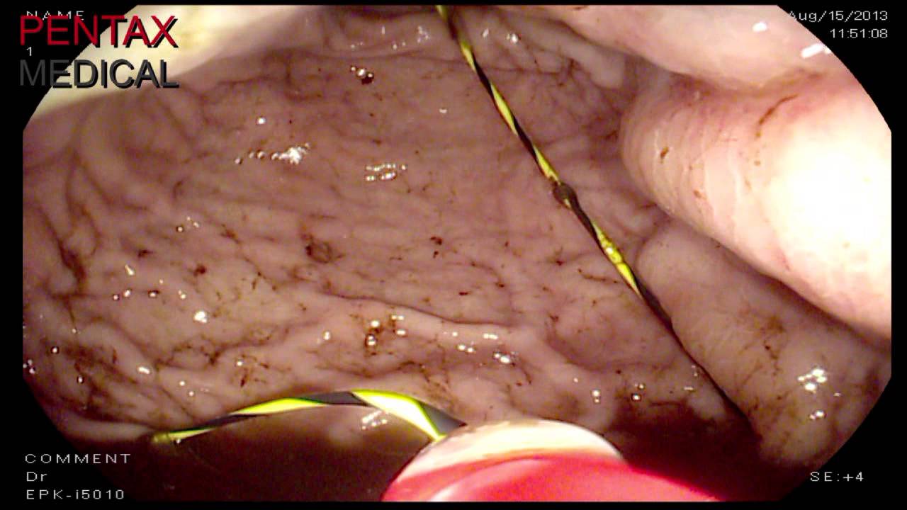 Estomago por dentro PENTAX MEDICAL - YouTube