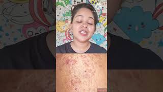 चहर क नशन और कल गडढ कस खतम कर Health Tips Shorts Videos Acne Treatment Pimples