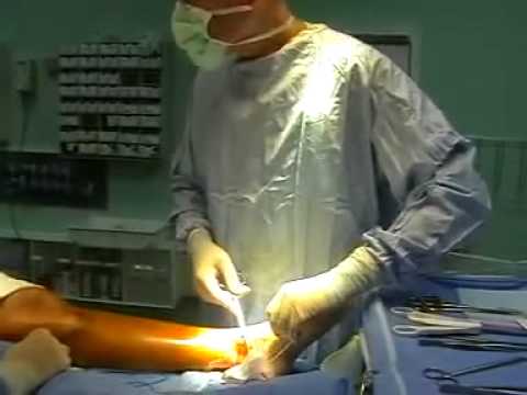Варикозное расширение вен нижних конечностей лечение народными средствами