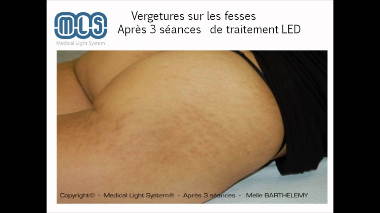 Longuent pour le retrait de la dorsalgie