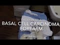 Re-upload - Derm surgery: excision of basal cell carcinoma