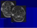 Neuroradiology Head & Neck Imaging Teaching Case 3.wmv