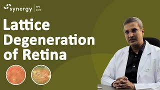 Lattice Degeneration Retinal Laser Treatment