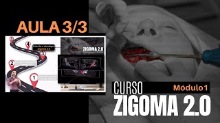 AULA 3 de 3 - Curso Zigoma 2.0 - Introdução aos Implantes Zigomáticos